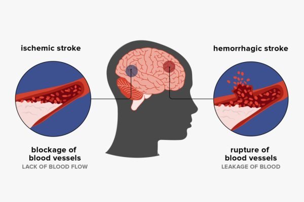 cerebrovascular-disease-2048×2048-instagram-1024×1024 cerebrovascular-disease-2048x2048-instagram-1024x1024